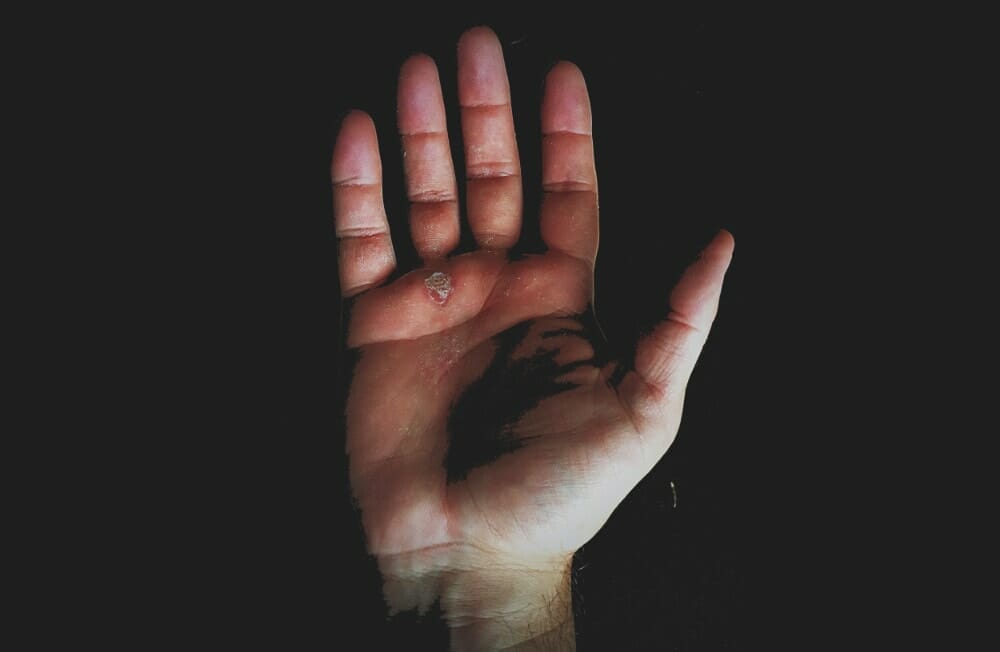 hand with blisters from working out
